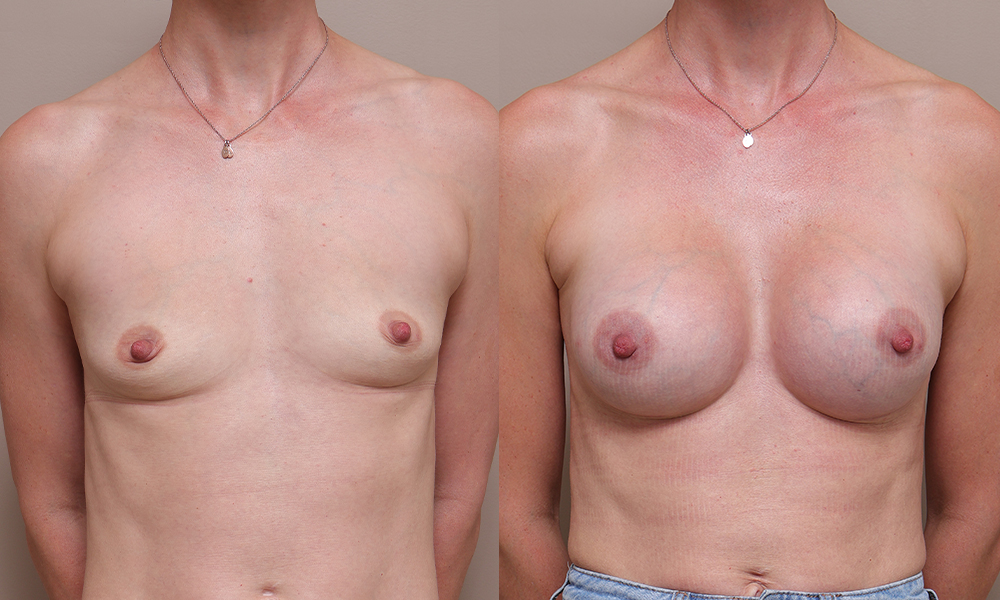 BreastAug img2 Gallery Breast Augmentation - 12