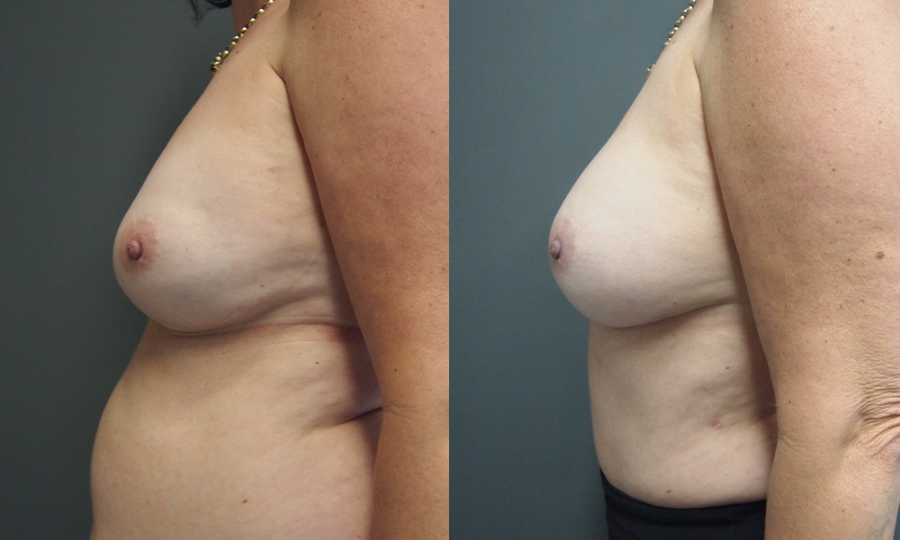 BreastReconstruction 2 Gallery DIEP Flap Breast Reconstruction - 9