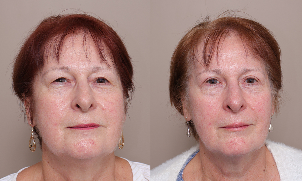 Blepharoplasty img 1 1 Gallery Blepharoplasty - 8