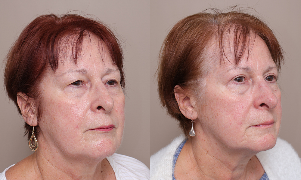 Blepharoplasty img 1 2 Gallery Blepharoplasty - 9