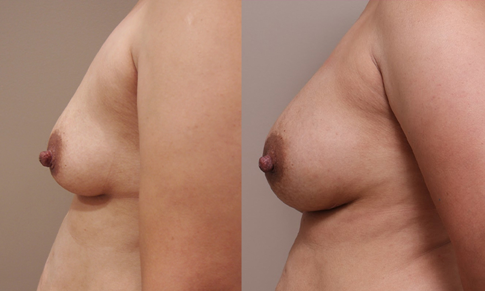 Breast Aug img 2 2 Gallery Breast Augmentation - 8