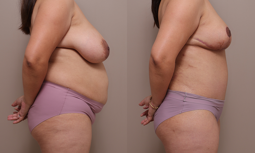 Breast Reduction Abdo img 1 3 Gallery Abdominoplasty - 12