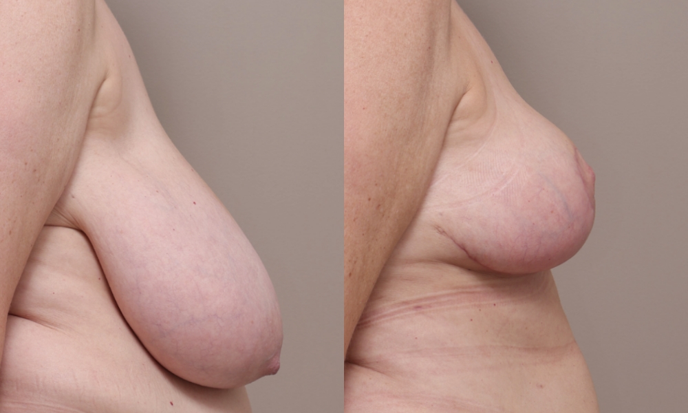 Breast Reduction Asymmetry img 1 3 Gallery Breast Asymmetry - 3