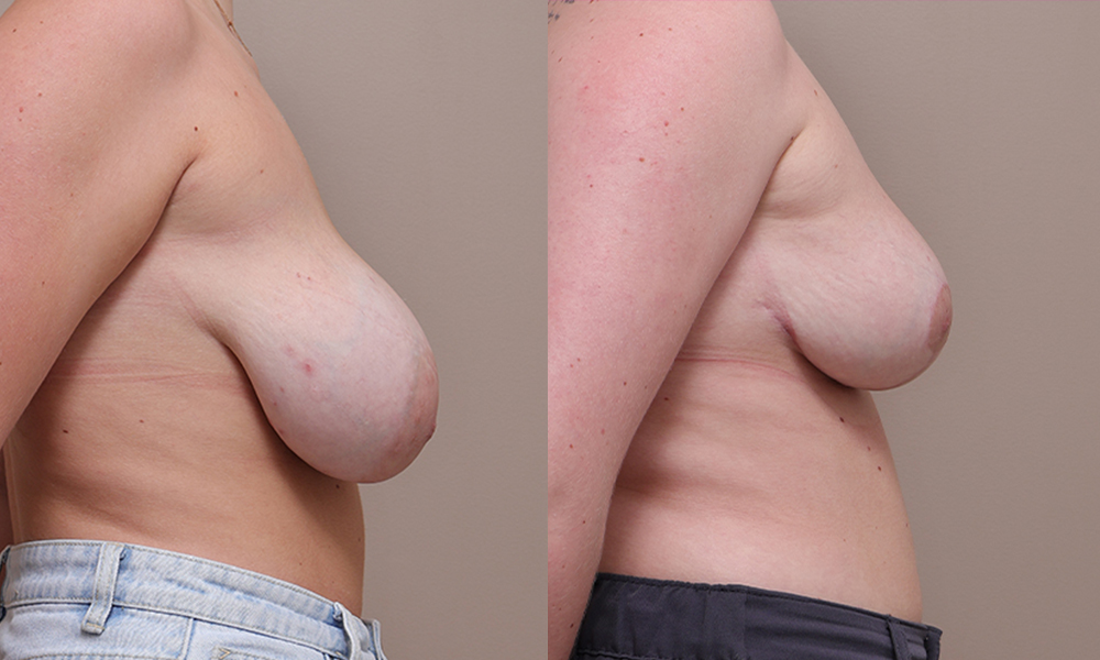 Breast Reduction img 1 3 Gallery Breast Reduction - 12