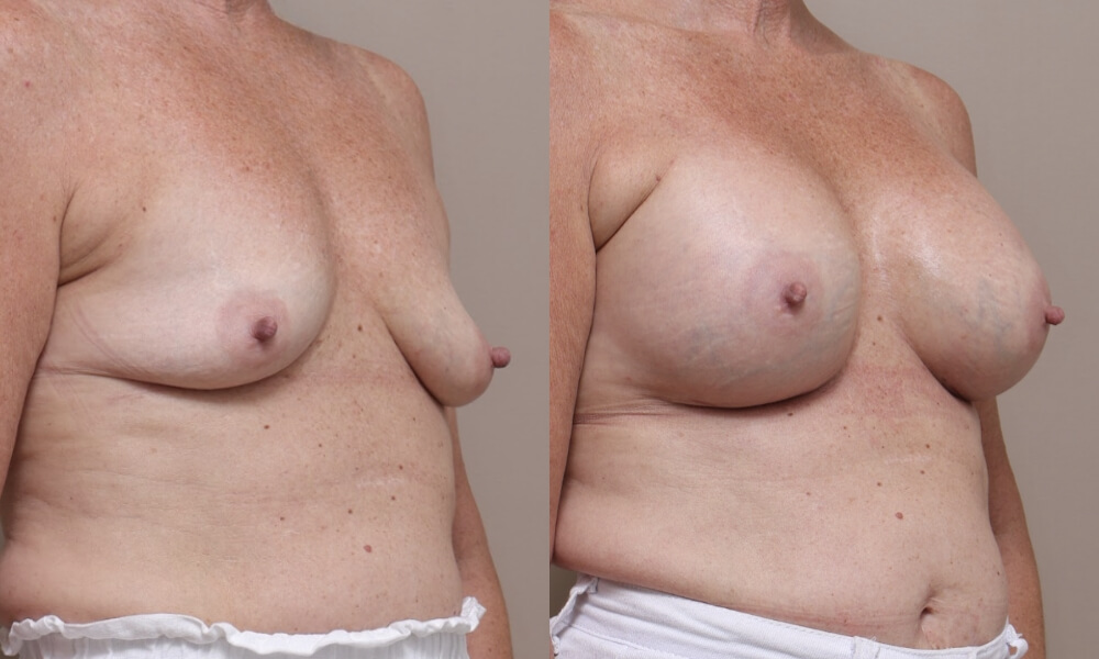 Breast Augmentation Patient 4 2 Gallery Breast Augmentation - 5