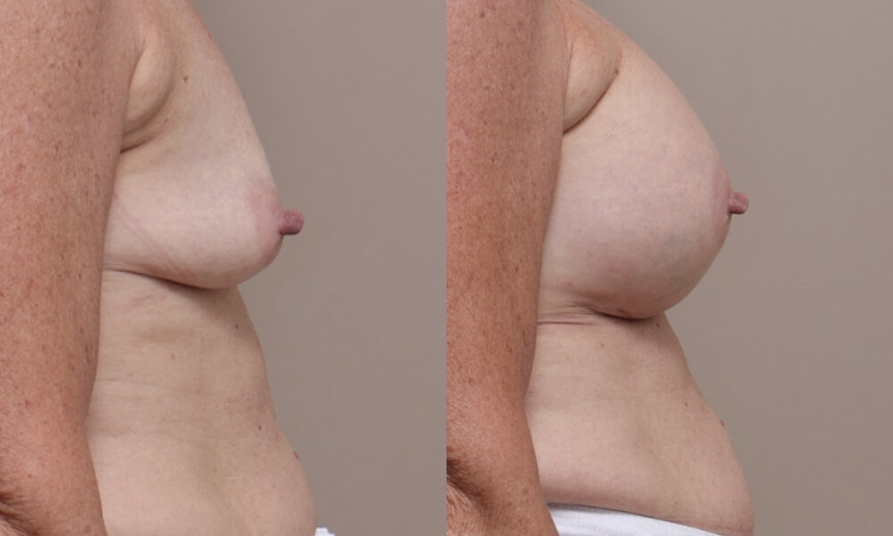 Breast Augmentation Patient 4 3 Gallery Breast Augmentation - 6