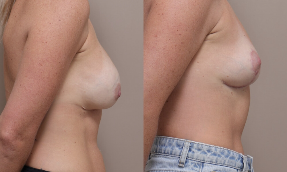 Breast Prosthesis Removal Mastopexy Patient 1 3 Gallery Breast Lift Mastopexy - 12
