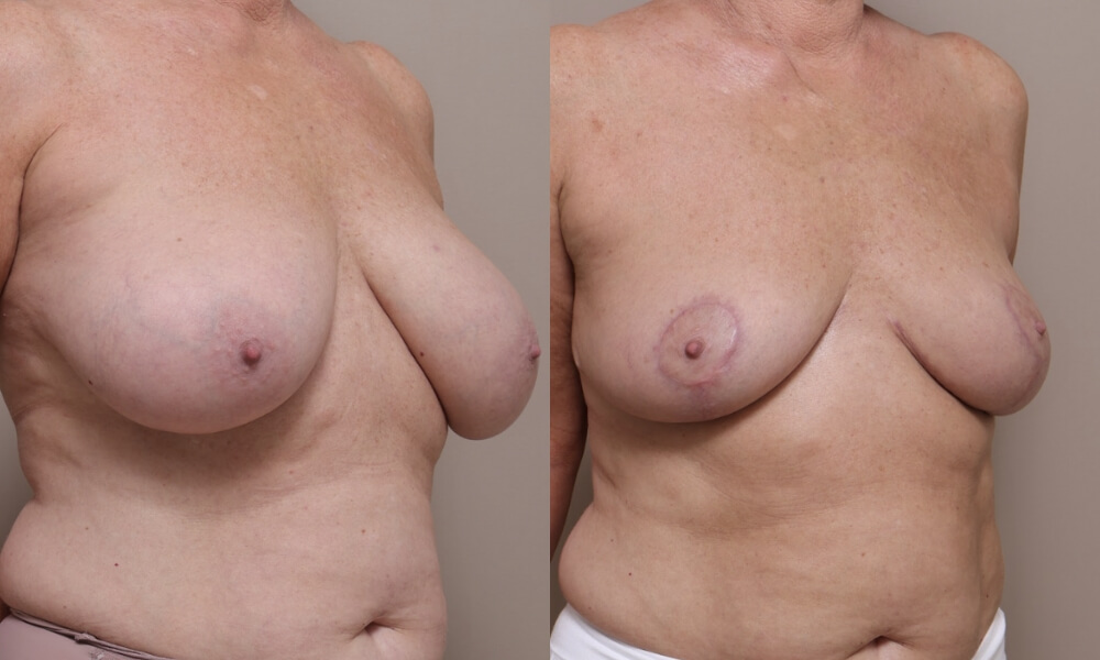 Breast Reduction Patient 2 3 Gallery Breast Reduction - 9