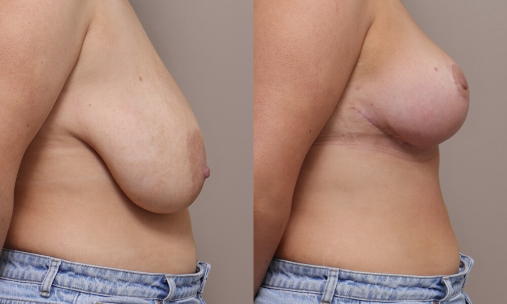 Breast Reduction Patient 3 1 Gallery Breast Reduction - 6