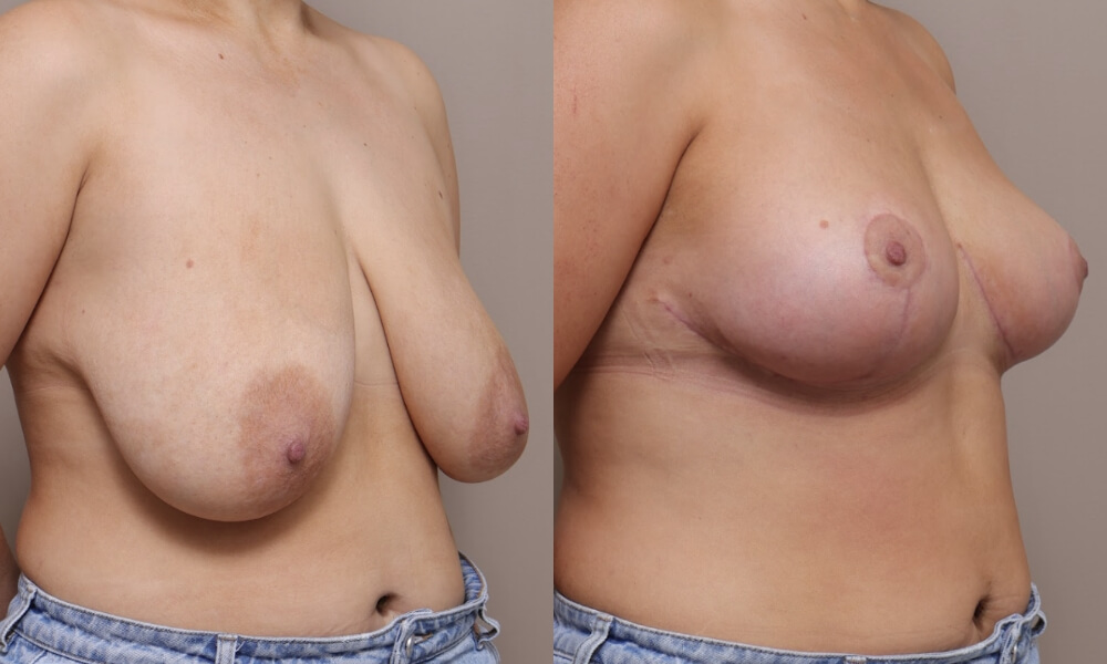 Breast Reduction Patient 3 3 Gallery Breast Reduction - 5