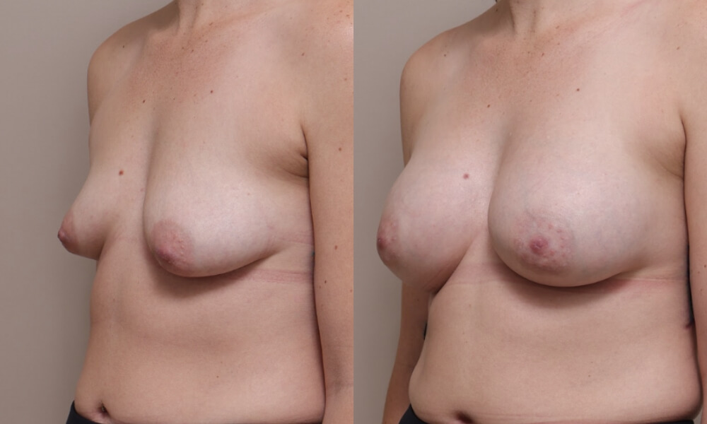 Tuberous Breast Correction 1 3 Gallery Tuberous Breast - 3