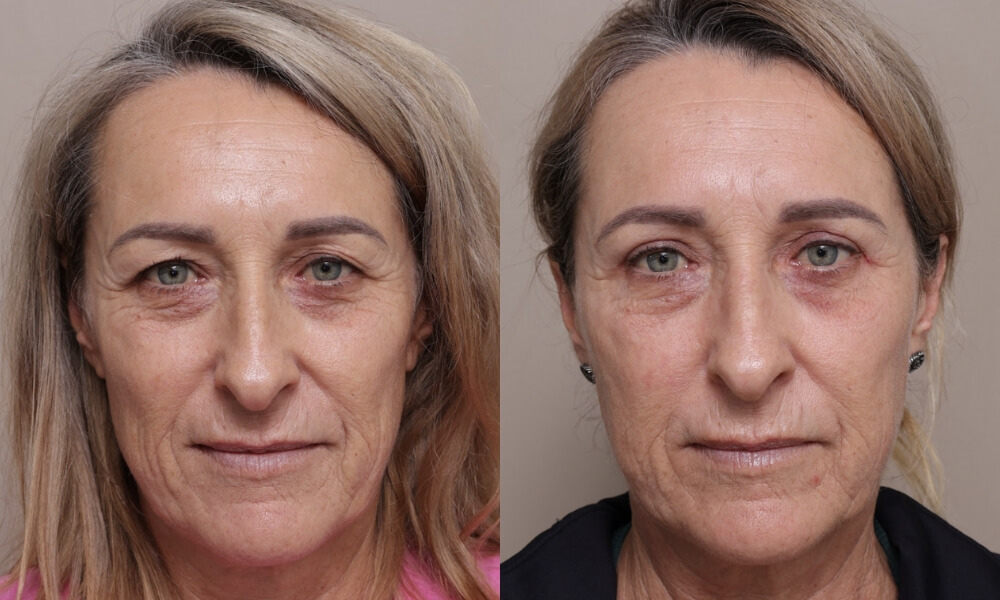 Upper Blepharoplasty patient 6 1 Gallery Blepharoplasty - 3