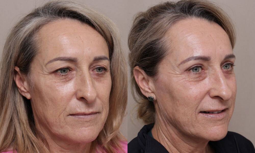 Upper Blepharoplasty patient 6 2 Gallery Blepharoplasty - 4