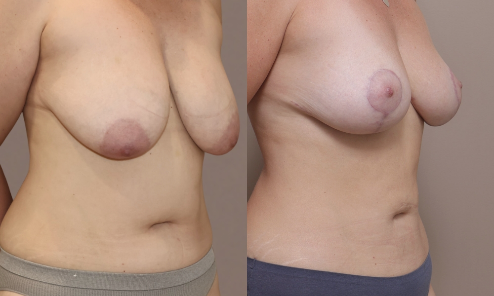 Breast Lift Mastopexy 1 2 Gallery Breast Lift Mastopexy - 8