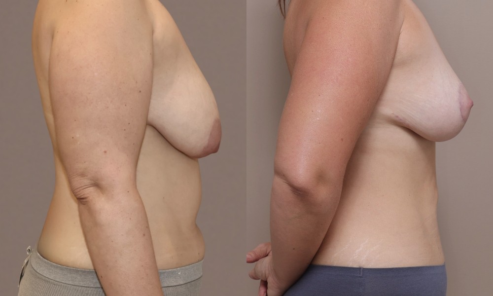 Breast Lift Mastopexy 1 3 Gallery Breast Lift Mastopexy - 9