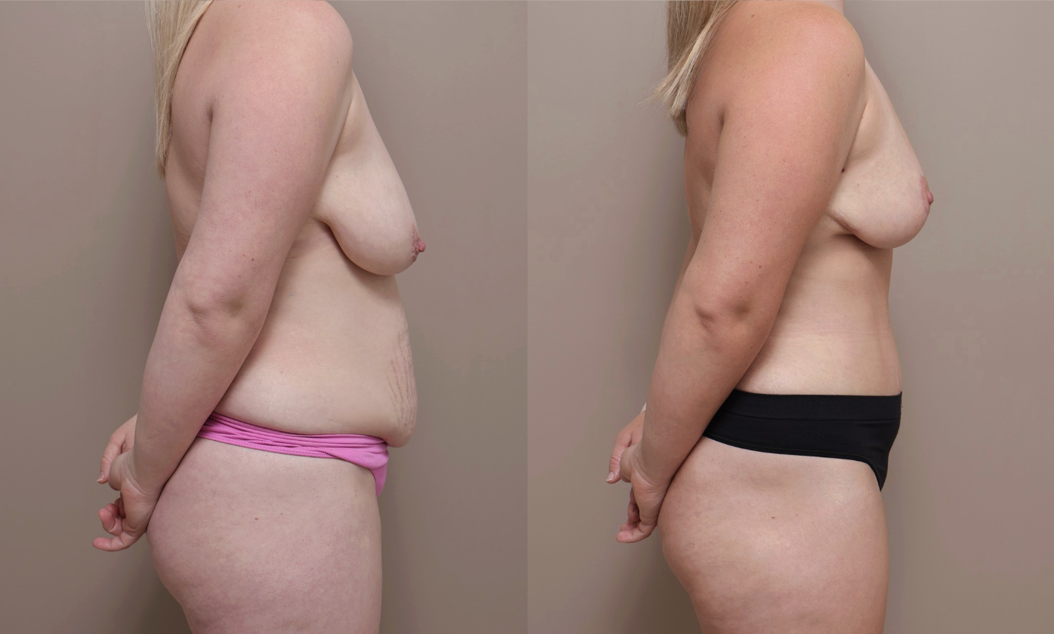 Screenshot 2026 04 23 at 1.10.39 PM Gallery Abdominoplasty - 6