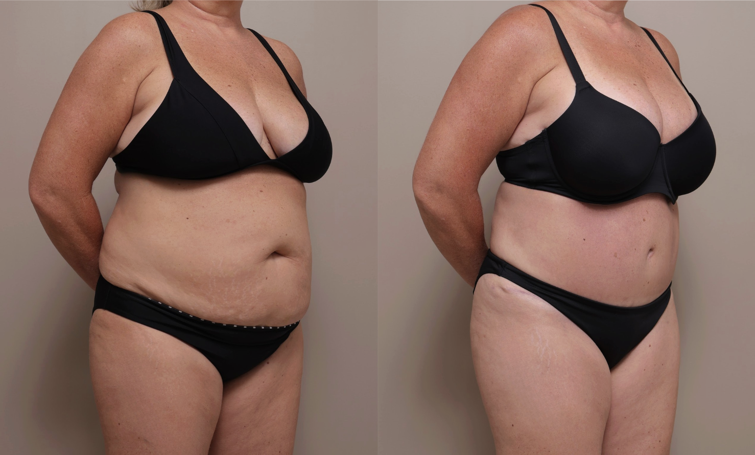 Screenshot 2026 04 23 at 12.34.08 PM Gallery Abdominoplasty - 8