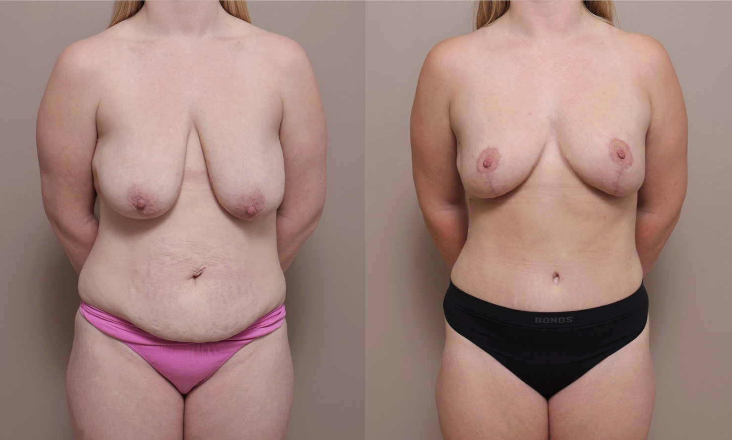 Screenshot 2026 04 23 at 12.50.30 PM Gallery Abdominoplasty - 4
