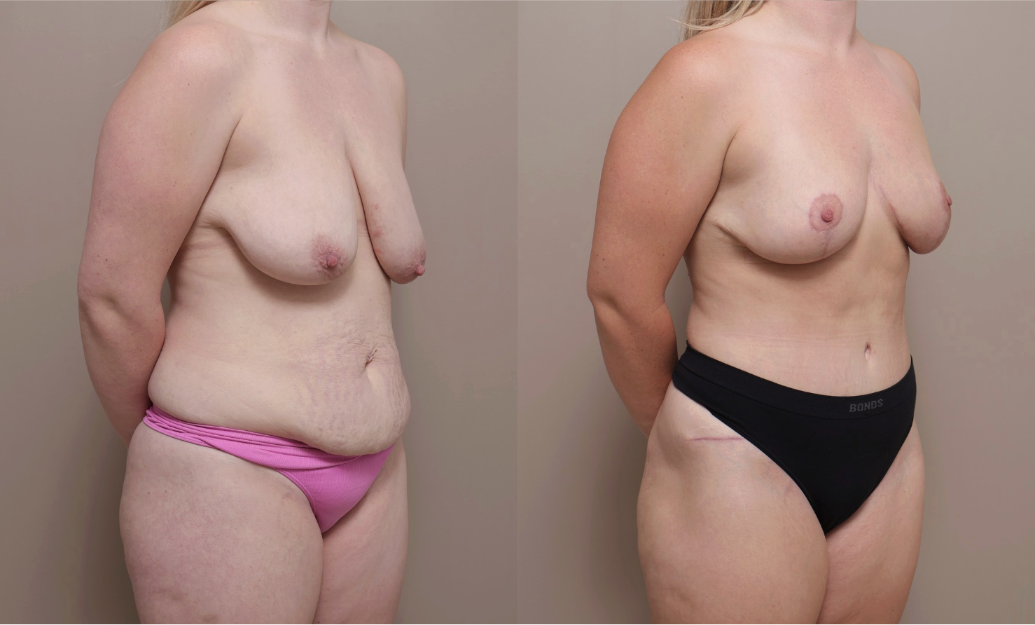Screenshot 2026 04 23 at 12.56.26 PM Gallery Abdominoplasty - 5