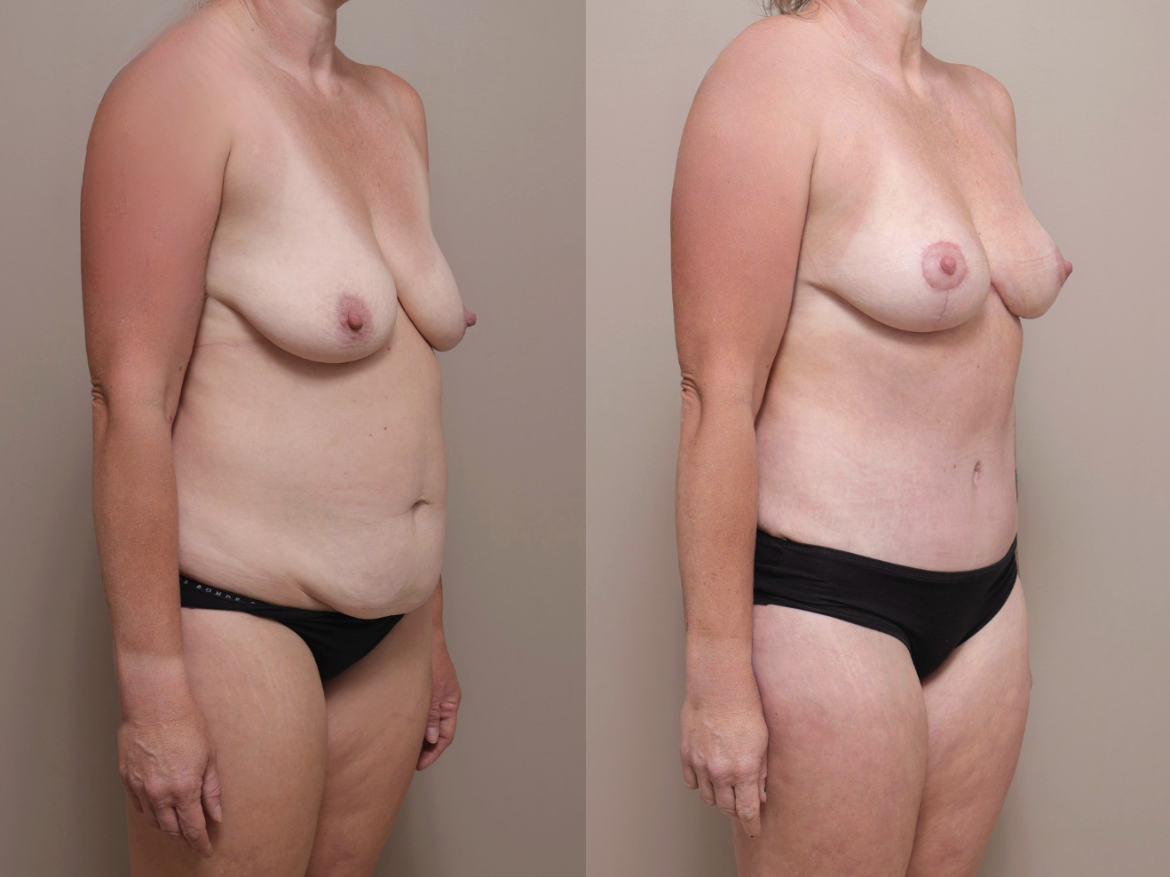 Screenshot 2026 04 28 at 10.49.06 AM Gallery Abdominoplasty - 2