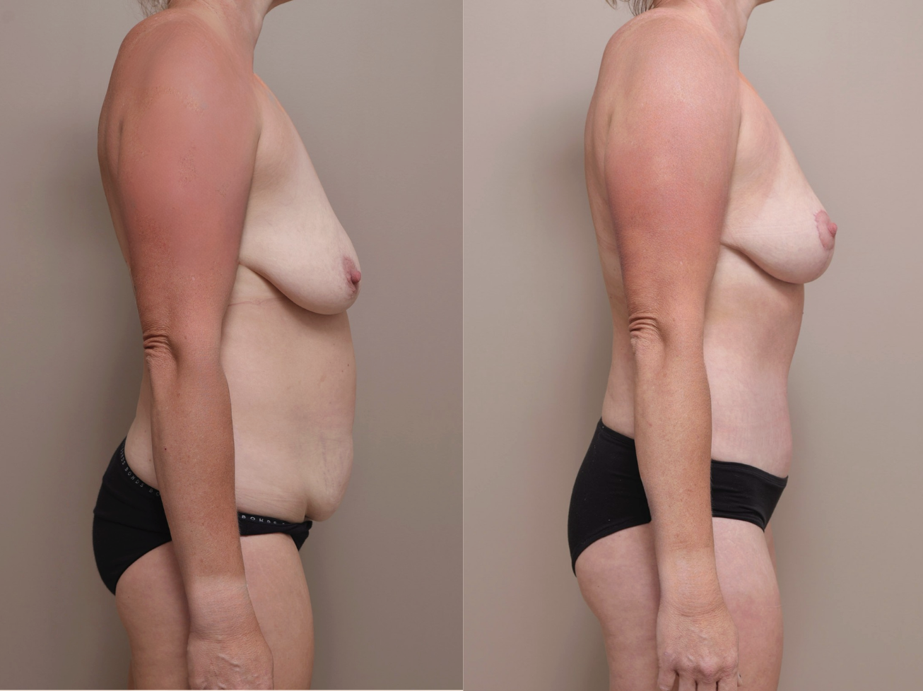 Screenshot 2026 04 28 at 10.49.32 AM Gallery Abdominoplasty - 3
