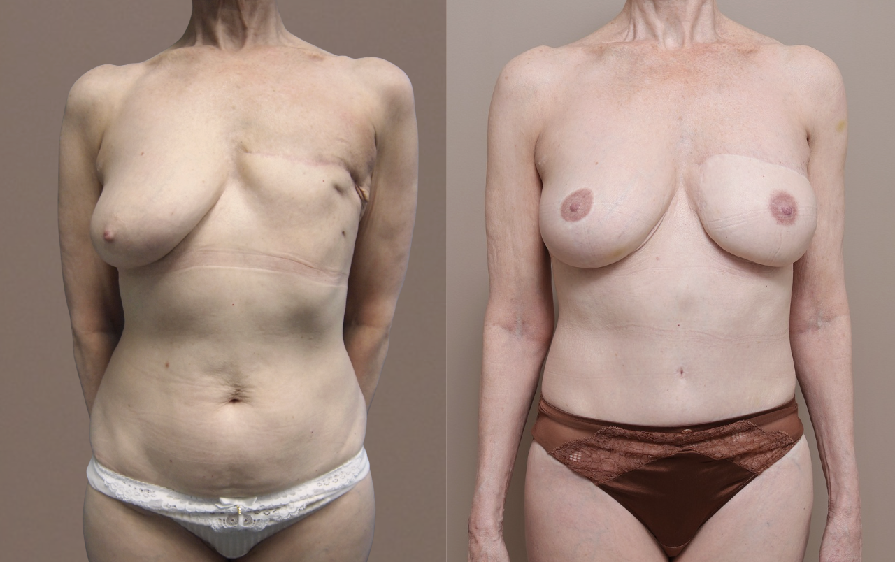 Screenshot 2026 04 28 at 11.45.44 AM Gallery Nipple Correction - 7