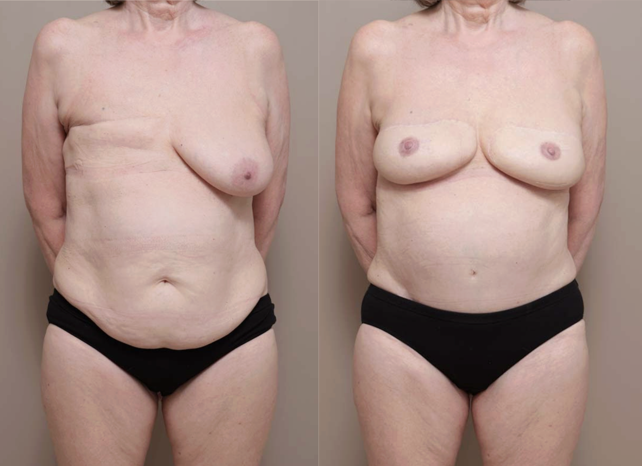 Screenshot 2026 04 28 at 12.00.52 PM Gallery Nipple Correction - 4