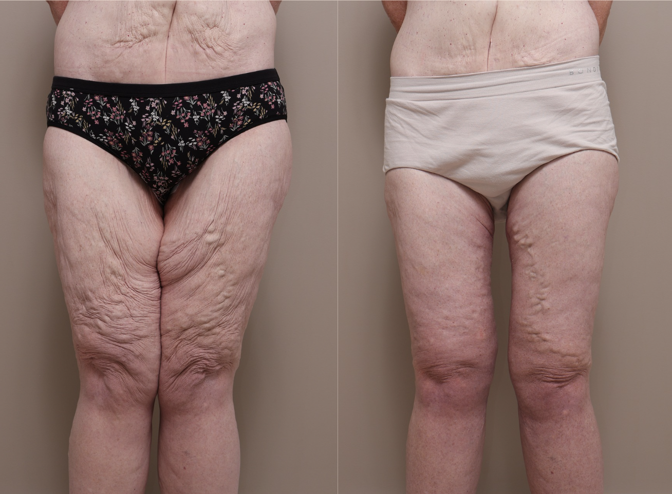 Screenshot 2026 04 30 at 1.59.54 pm Gallery Thigh Lift - 1