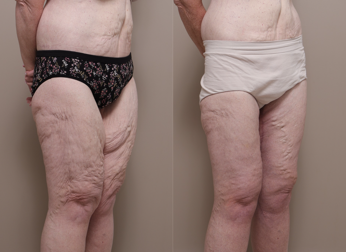Screenshot 2026 04 30 at 2.00.27 pm Gallery Thigh Lift - 2